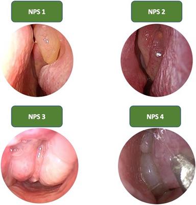 Diagnostic therapeutic assistance pathway (PDTA) of type 2 chronic rhinosinusitis